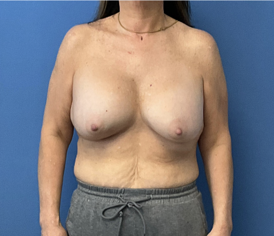 Breast-Revision-with-Lift--Patient-3947 | Before Breast Revision